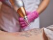 tattoo removal London